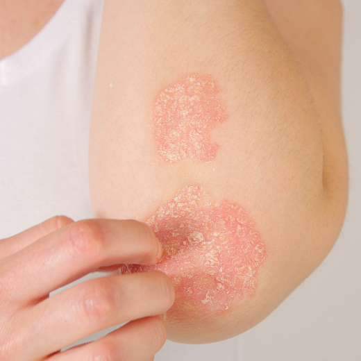 Ditch the Itch: Psoriasis Skin Care Tips