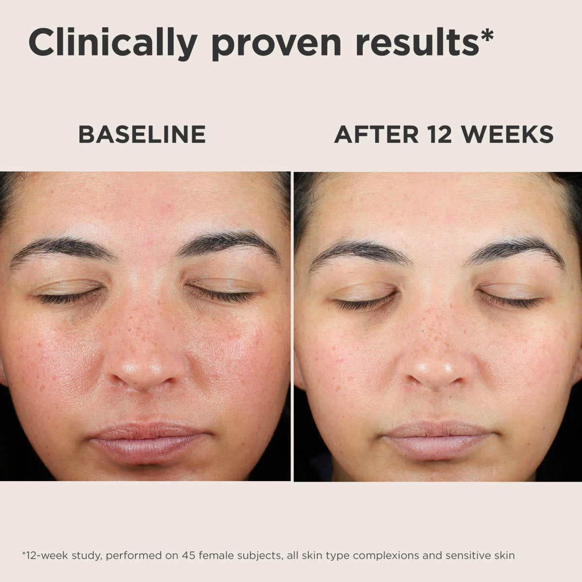EltaMD UV Skin Recovery Sunscreen Before and After Showing Reduced Redness
