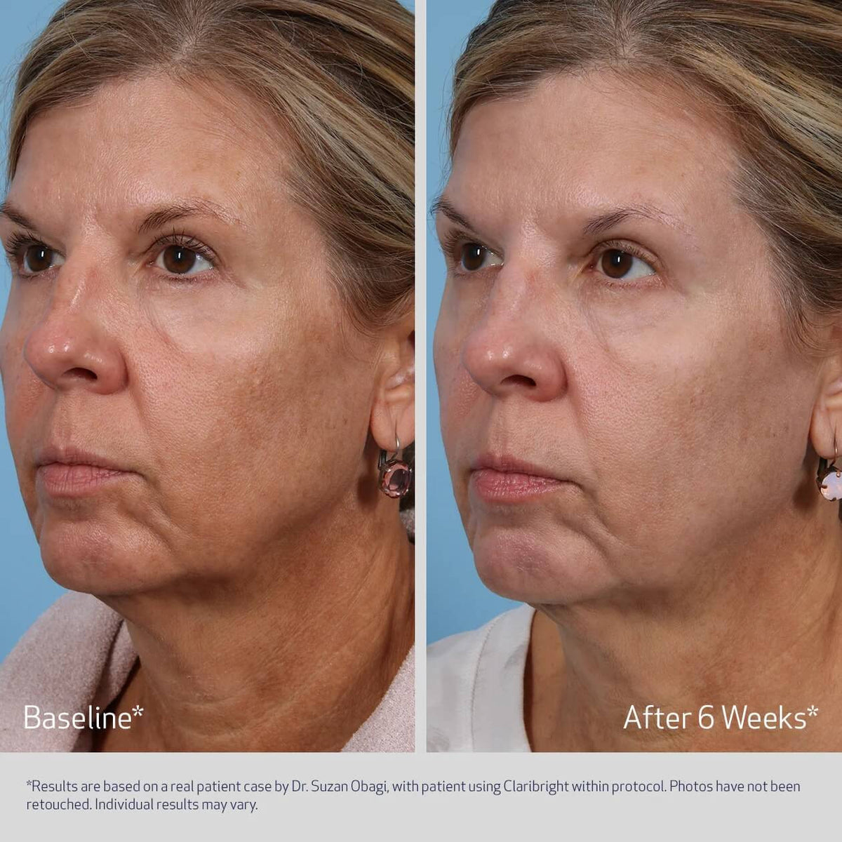 Obagi SUZANOBAGIMD® CLARIBRIGHT Radiance Brightening Lotion 1.7 fl oz  - SkinElite - before and after