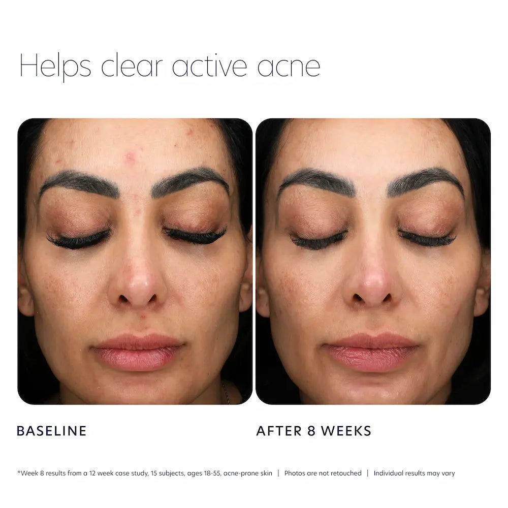 PCA SKIN Acne Control Prebiotic Gel Cleanser 7 oz before and after