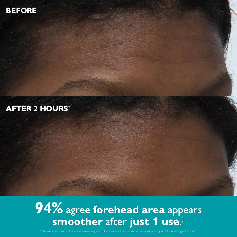 Peter Thomas Roth Peptide Skinjection Peptide Infused Face + Eye Tape before and after forehead