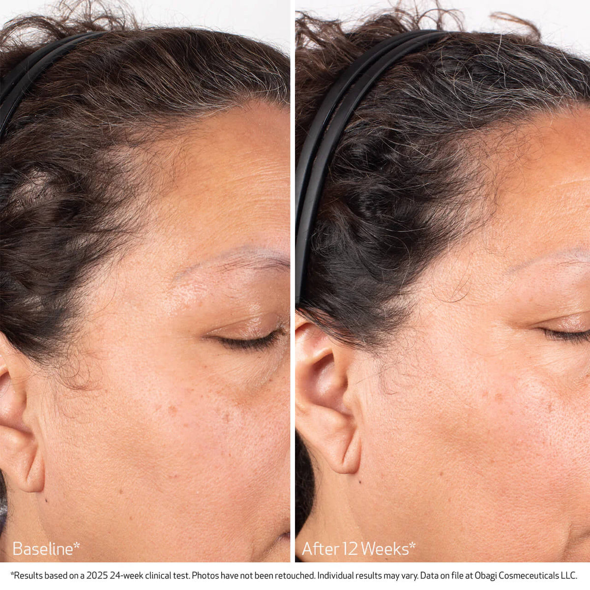 Obagi BIOSTIM™ Scalp Serum 2 fl oz - Skin Elite - Clinical Results 1