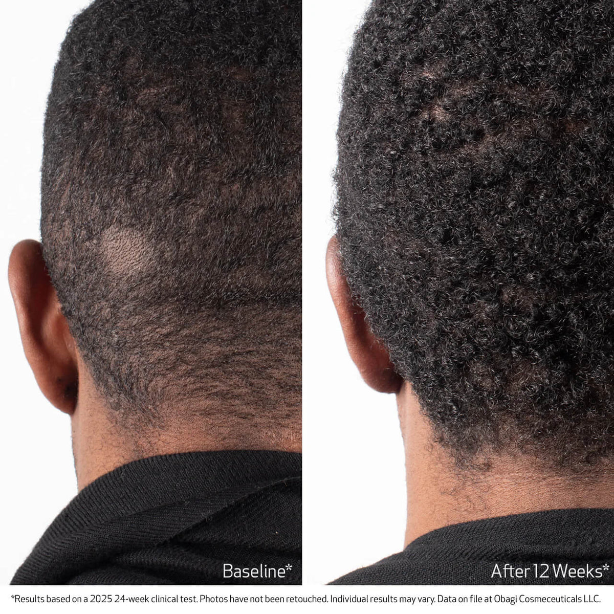 Obagi BIOSTIM™ Scalp Serum 2 fl oz - Skin Elite - Clinical Results 2