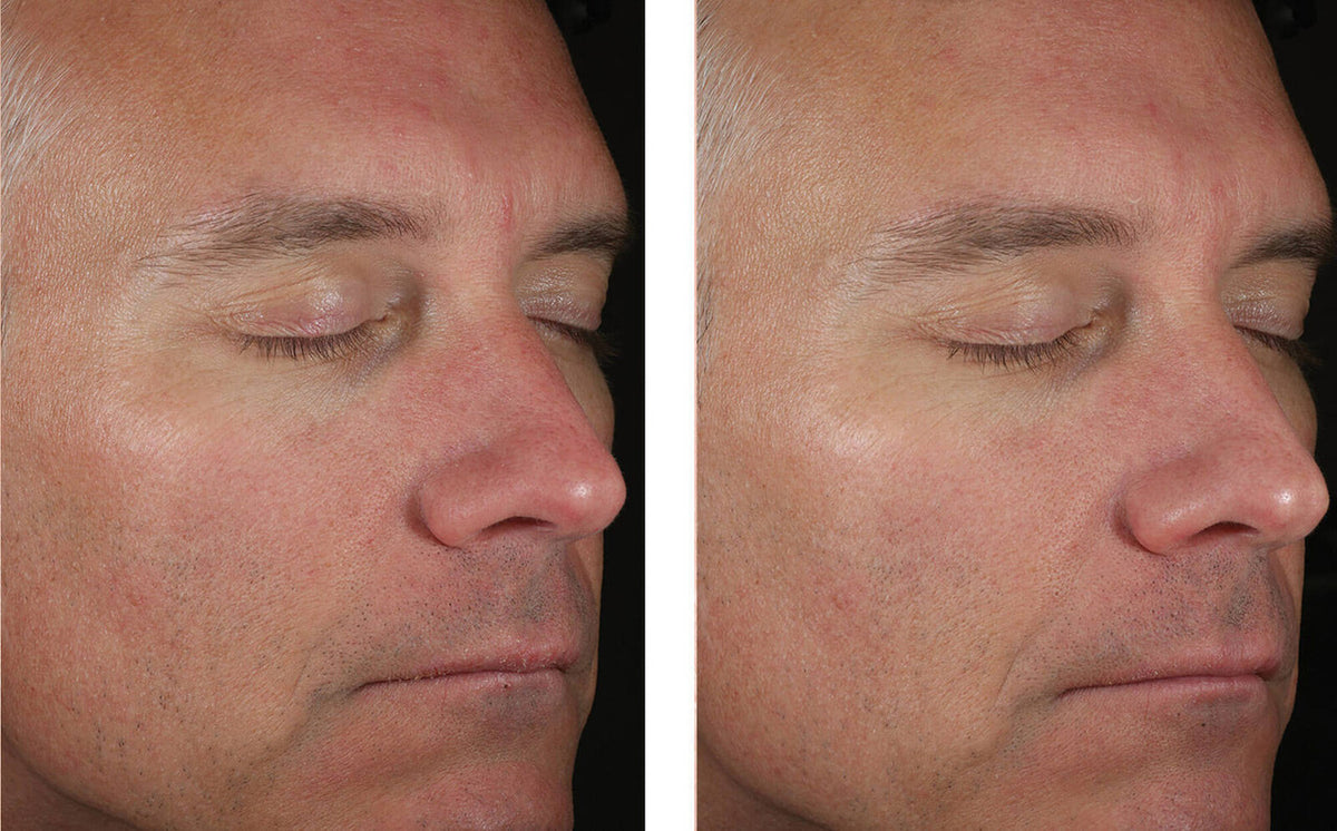SkinBetter Solo Hydrating Defense Men 1.7 fl oz - SkinElite - before and after 1