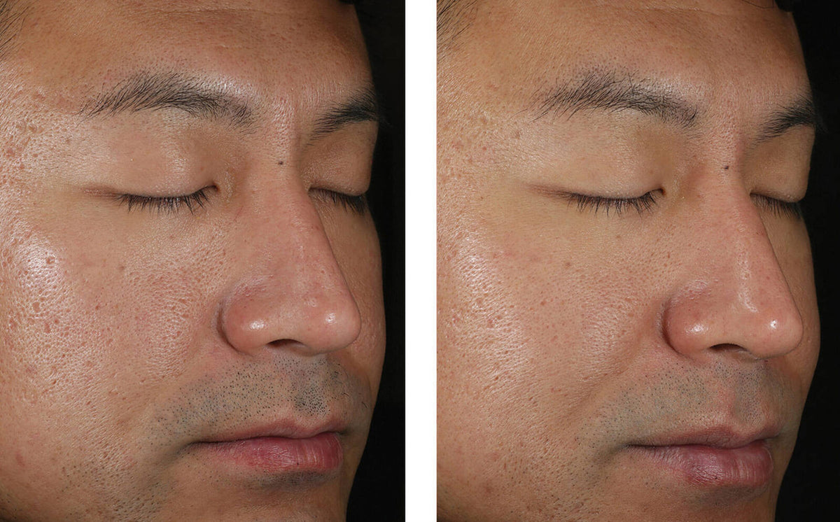 SkinBetter Solo Hydrating Defense Men 1.7 fl oz - SkinElite - before and after 4