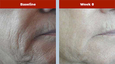 Biopelle Retriderm Serum Plus 1 fl oz - SkinElite - before and after 1