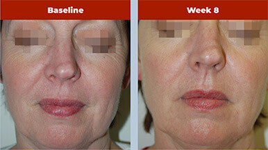 Biopelle Retriderm Serum Max 1 fl oz - SkinElite - before and after 3