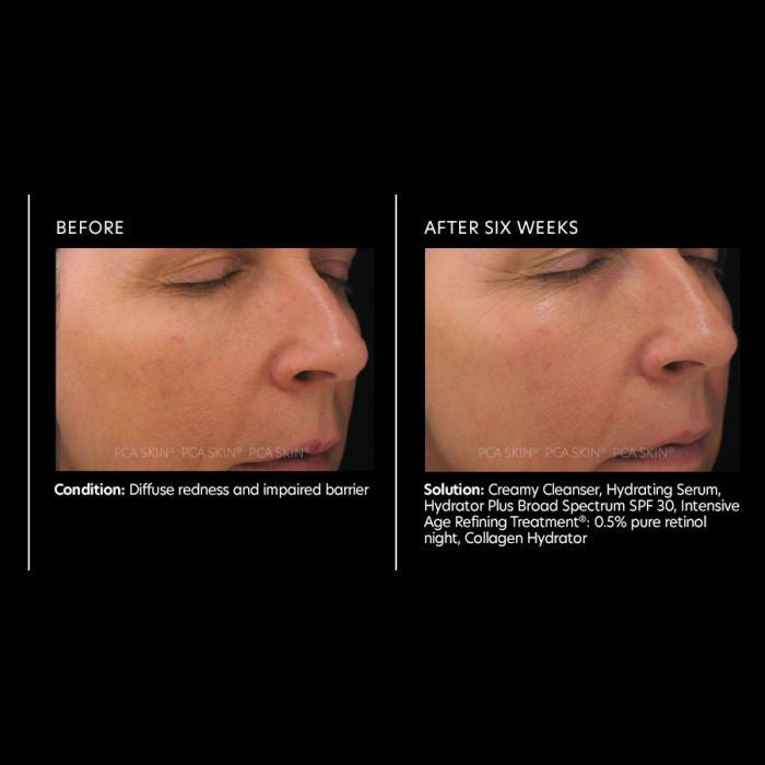 PCA Skin Intensive Age Refining Treatment 0.5% Retinol 1 fl oz - results